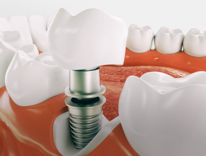 Thousand Oaks Dental Implants